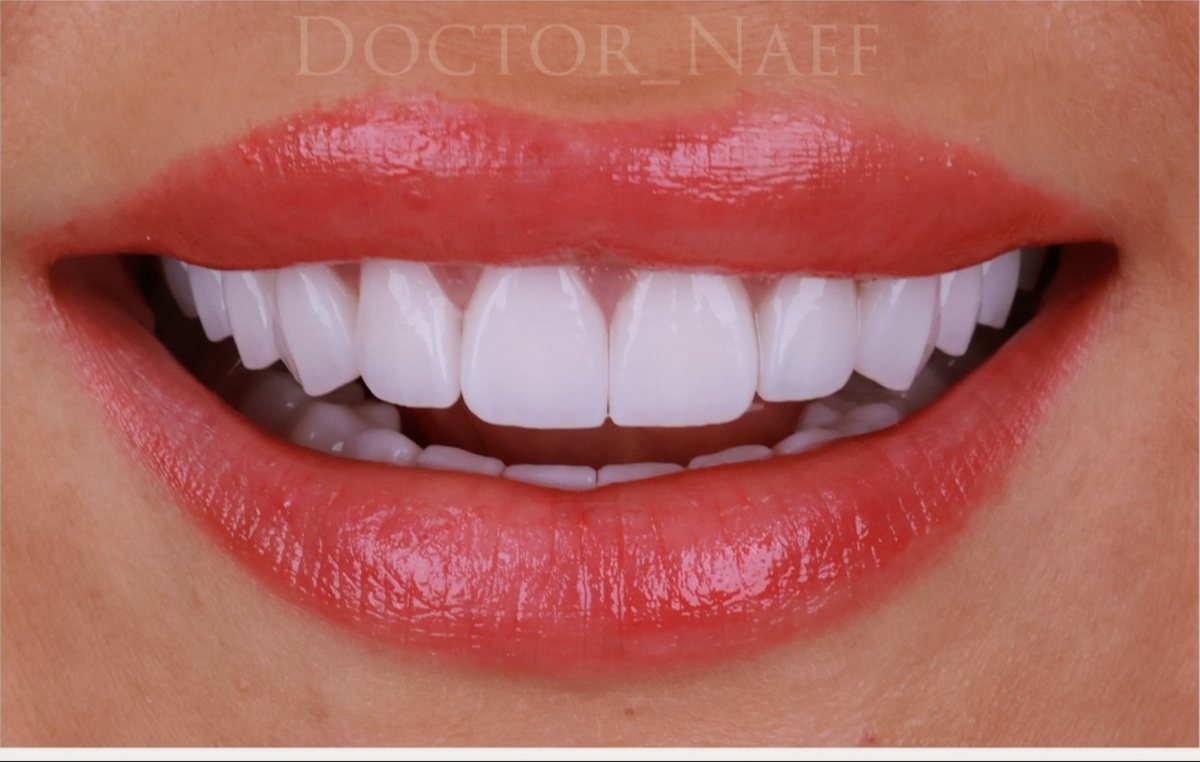 Efter – Hollywood Smile i zirkonia