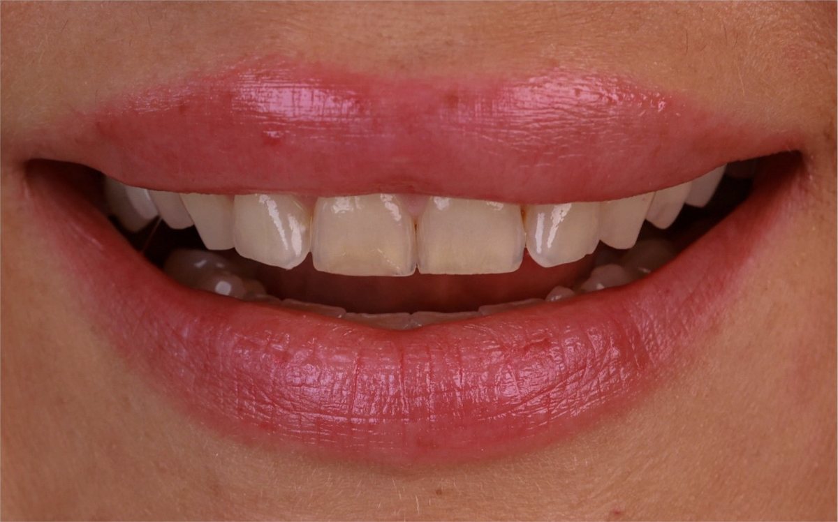 Före – Hollywood Smile i zirkonia