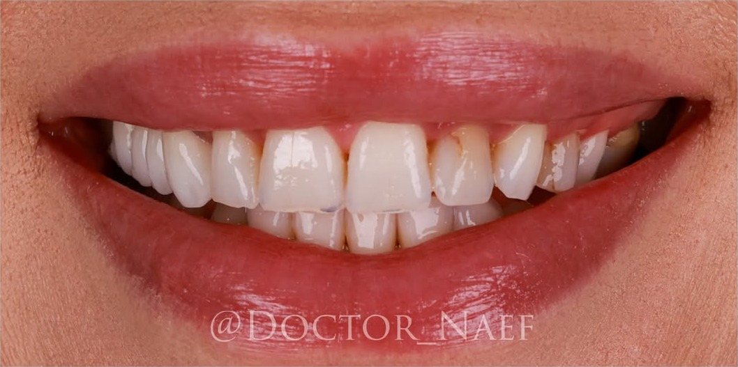 Före – Hollywood Smile i zirkonia