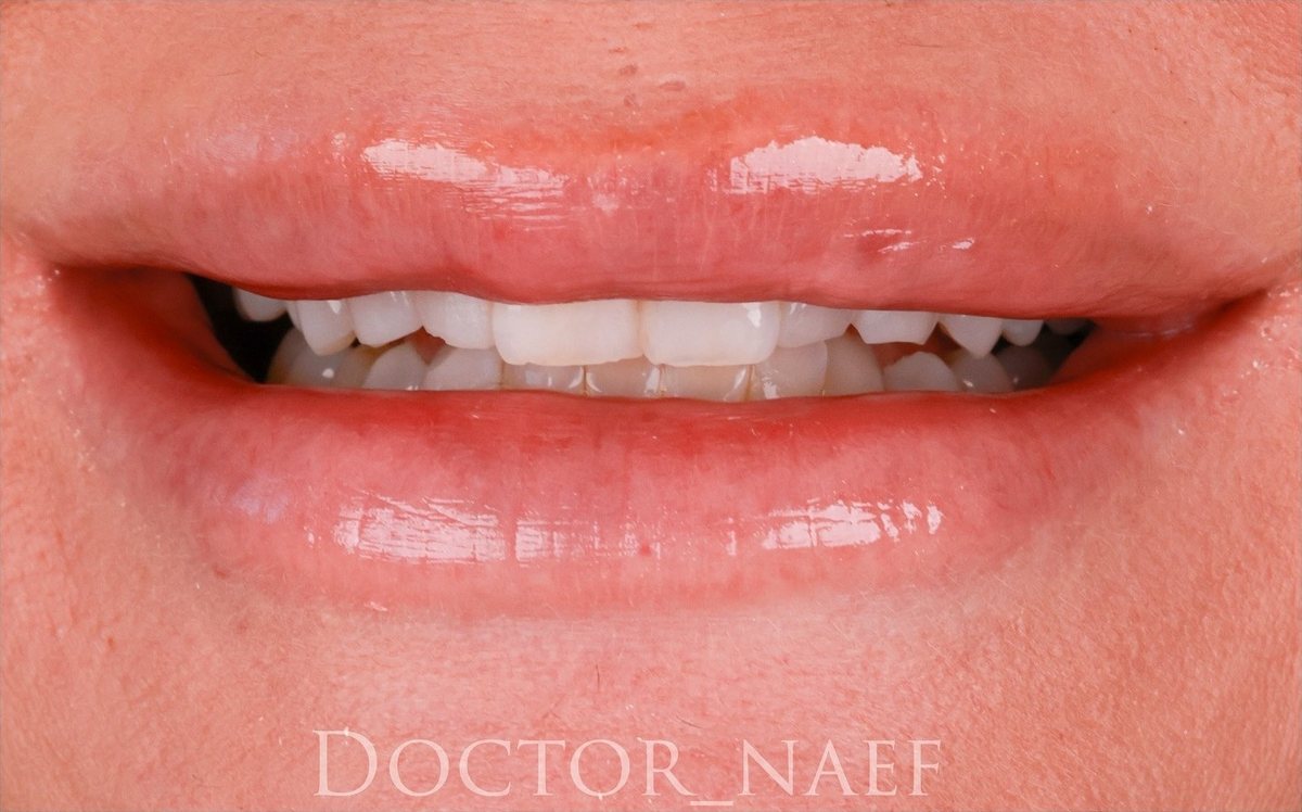 Före – Före och efter