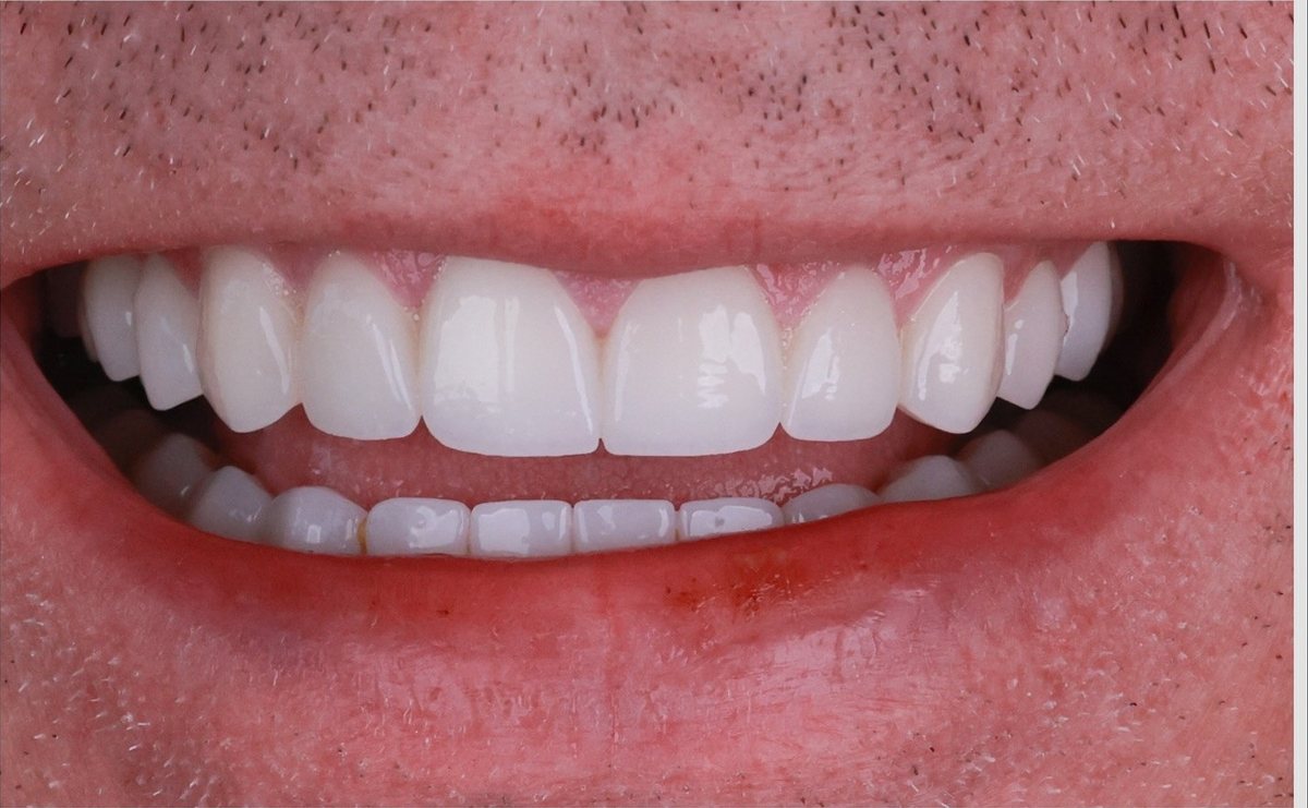After – Hollywood Smile in zirconia
