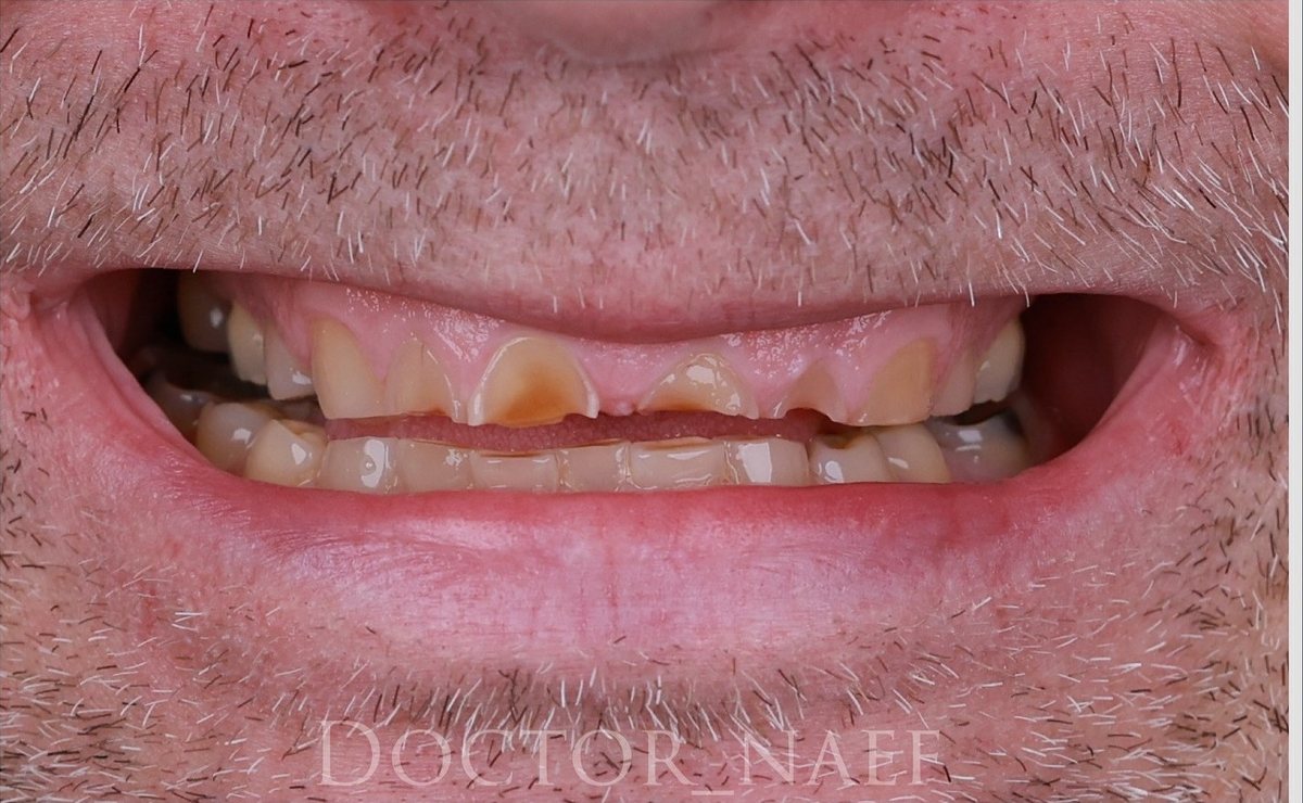 Before – Hollywood Smile in zirconia