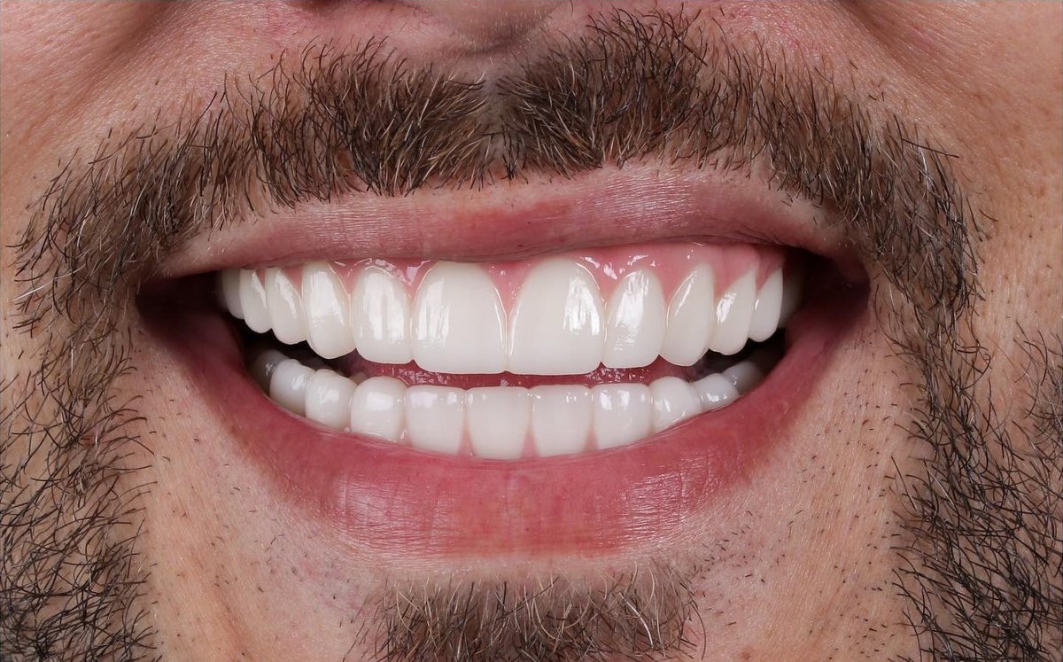 After – Hollywood Smile in zirconia