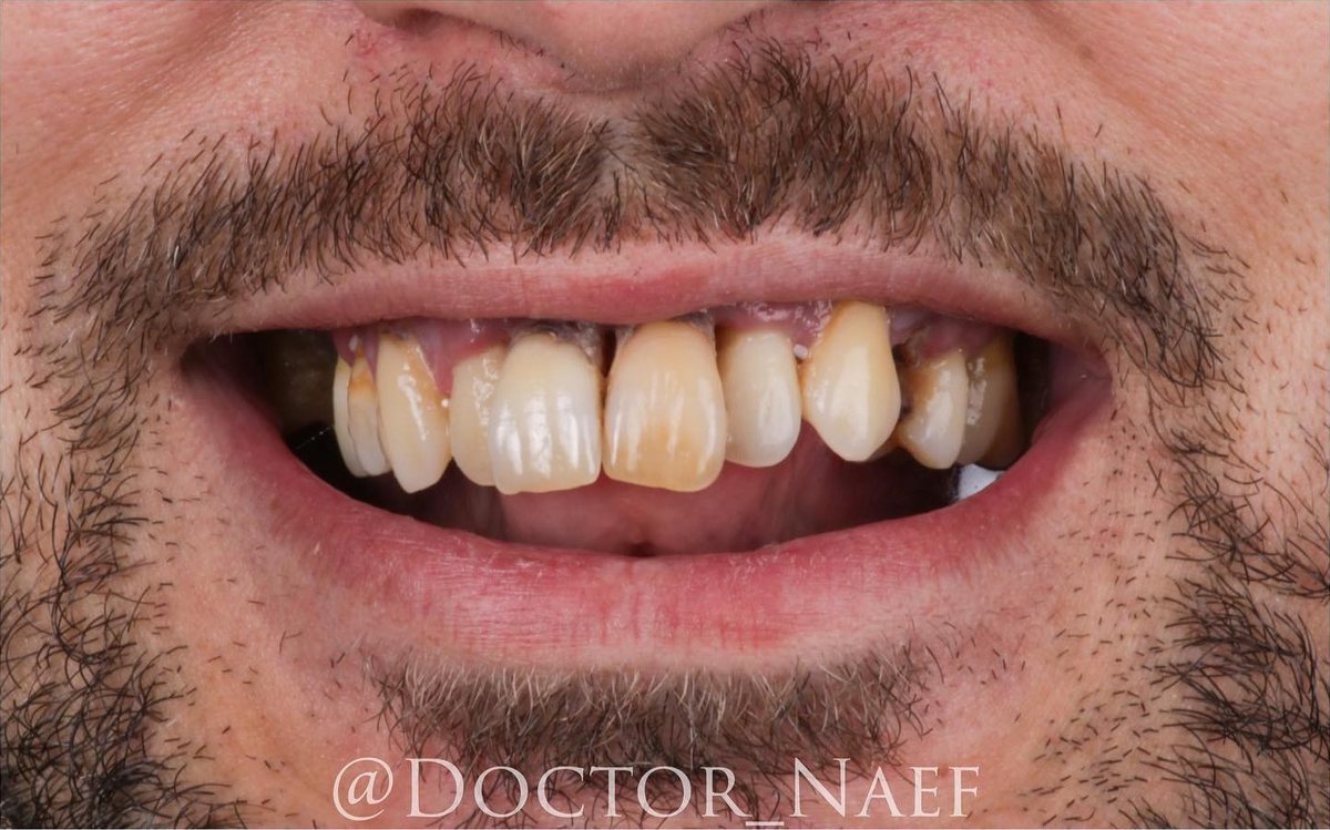 Before – Hollywood Smile in zirconia