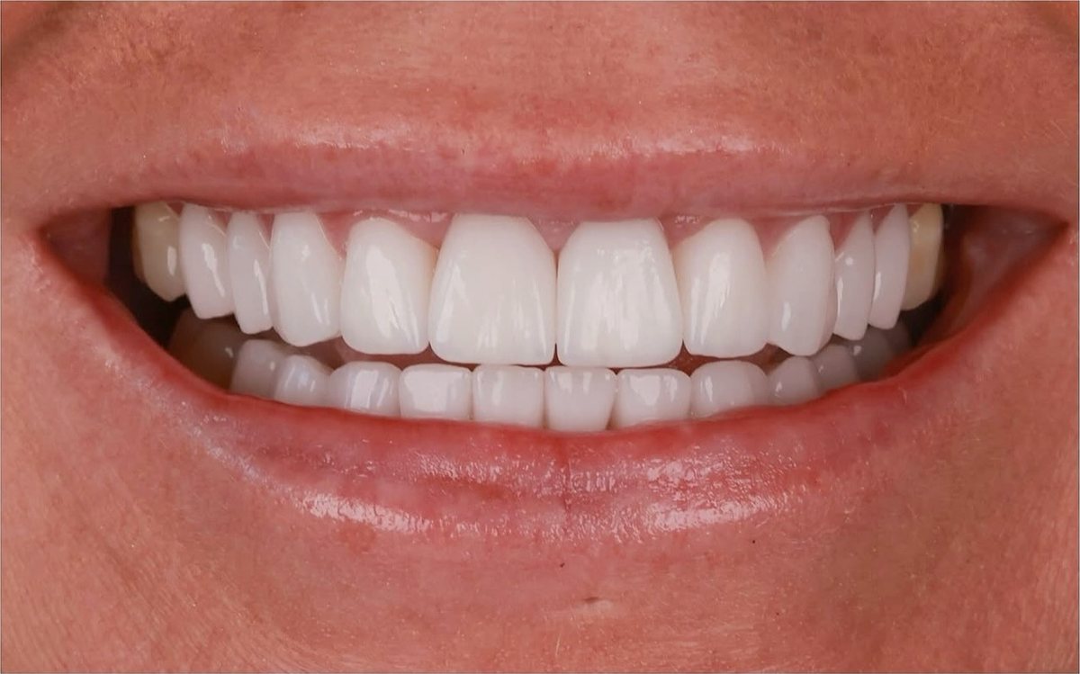 After – Hollywood Smile in zirconia