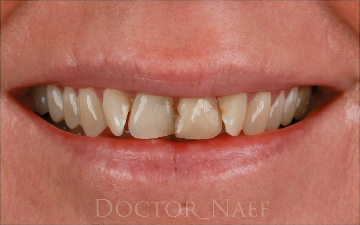 Före – Hollywood Smile i zirkonia