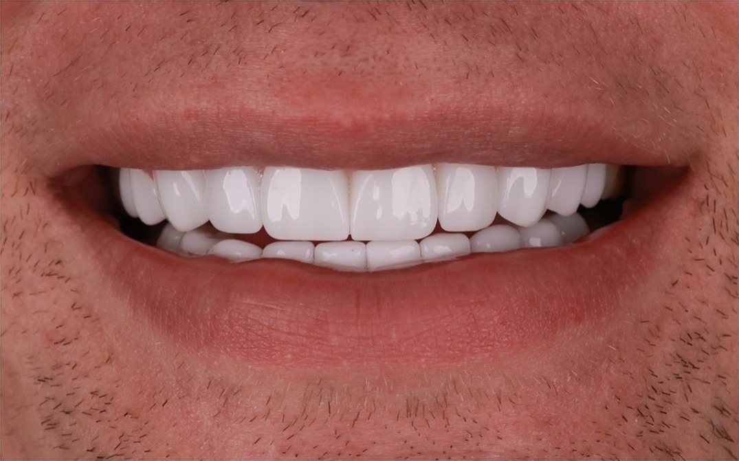 After – Hollywood Smile in zirconia