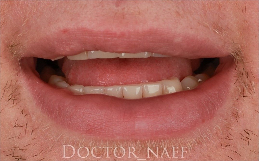 Before – Hollywood Smile in zirconia