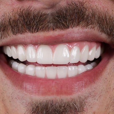 Smile with fixed full-arch zirconia bridges on implants – after treatment